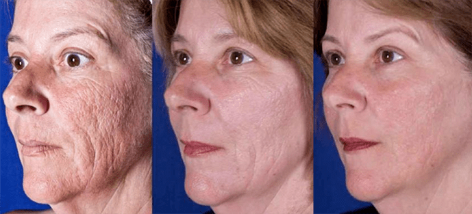 Résultat après la procédure de rajeunissement de la peau du visage au laser