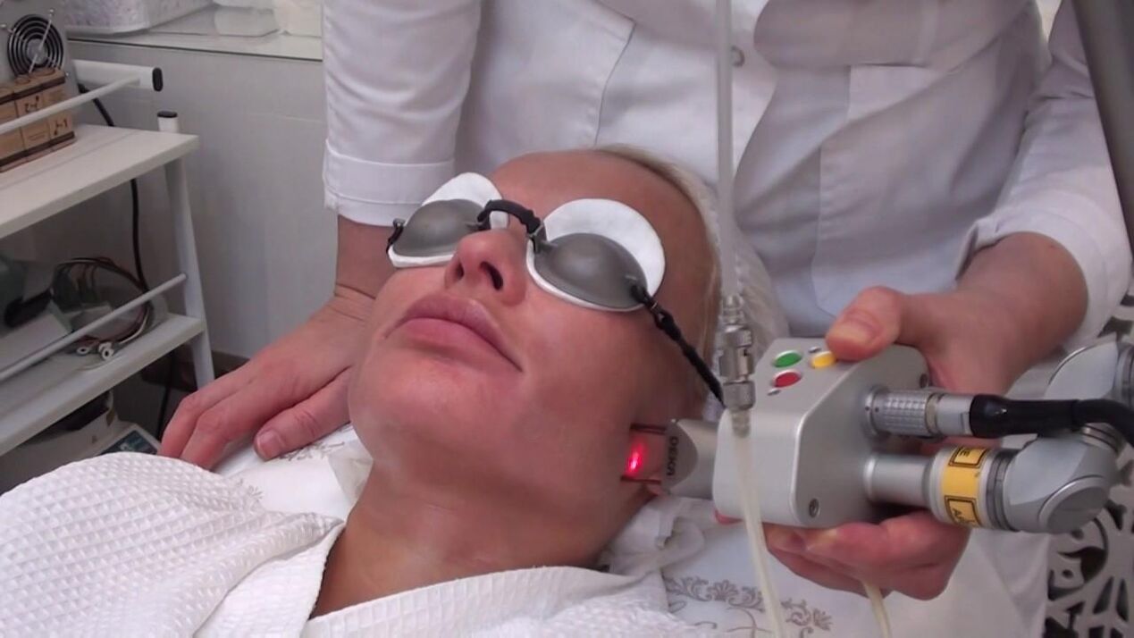 Traitement avec un faisceau laser des zones à problèmes de la peau du visage