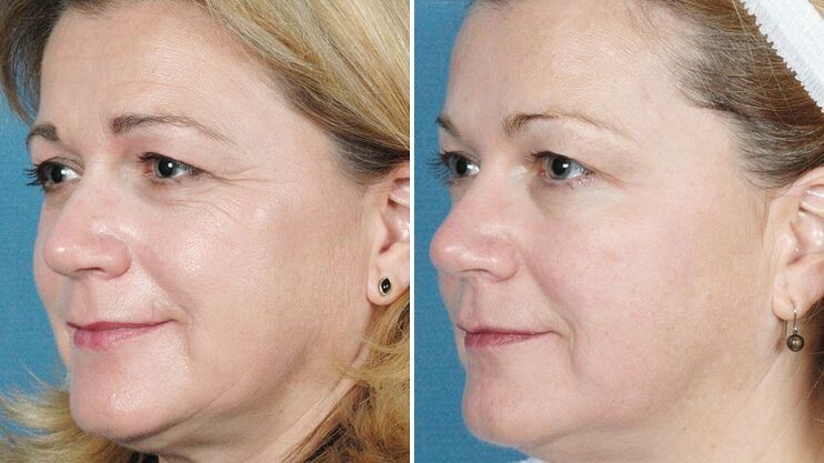 photos avant et après le rajeunissement de la peau du matériel