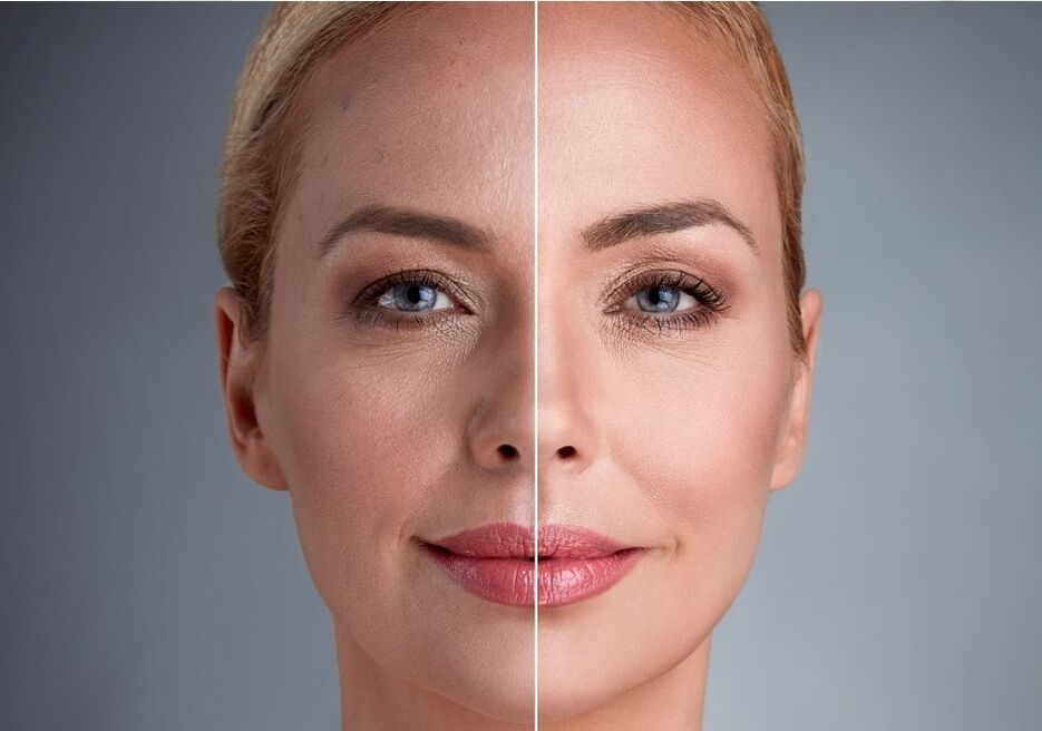 avant et après rajeunissement facial au laser